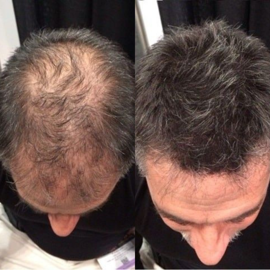 LUMIN - RRB Hair Growth Gummies