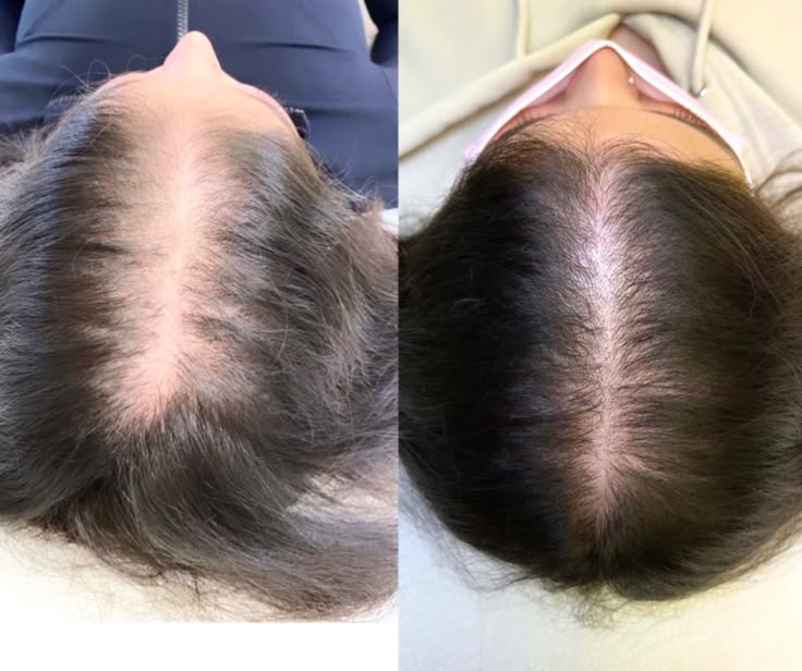 LUMIN - RRB Hair Growth Gummies