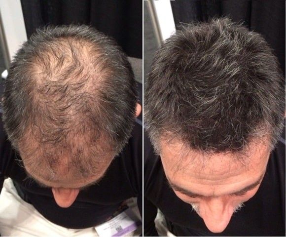 LUMIN - RRB Hair Growth Gummies
