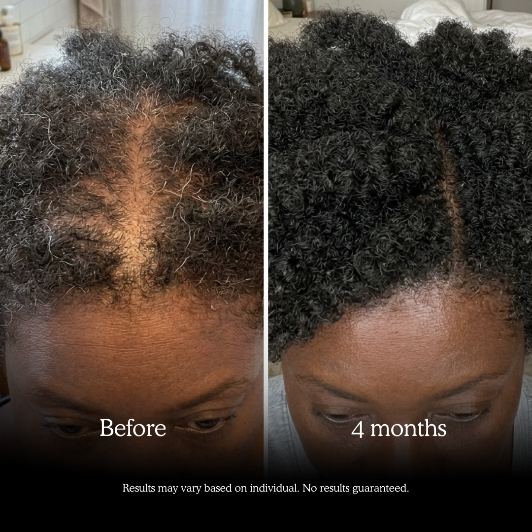 LUMIN - YGG-Hairloss