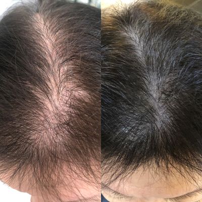 LUMIN - RRB Hair Growth Gummies